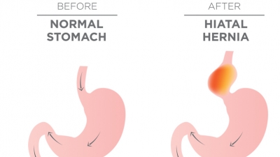 Αντιμετώπιση της διαφραγματοκήλης με ρομποτική χειρουργική