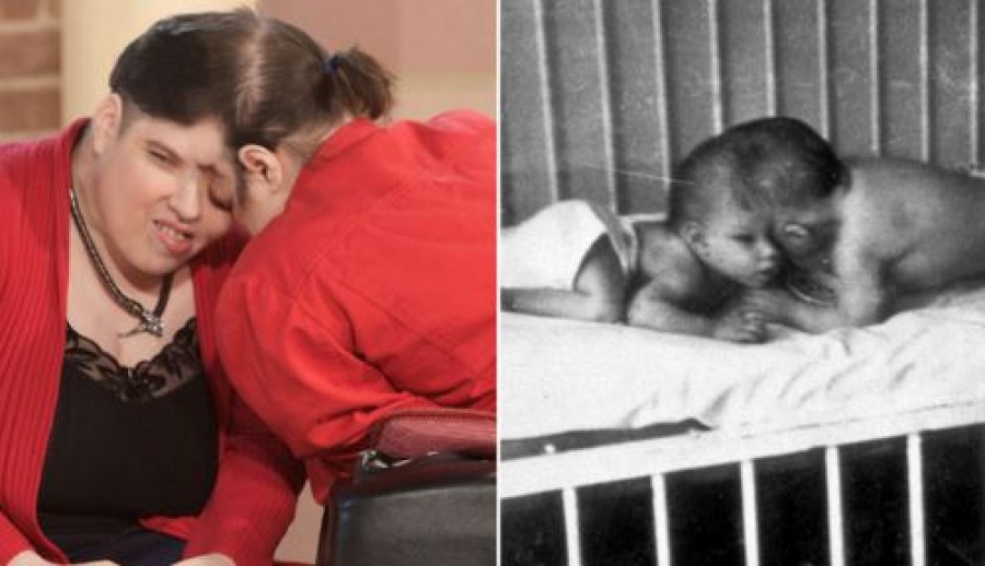 Πέθαναν τα γηραιότερα σιαμαία δίδυμα: Aψήφησαν γιατρούς, μπήκαν στο βιβλίο Guiness έζησαν 62 χρόνια κολλημένοι στο κεφάλι