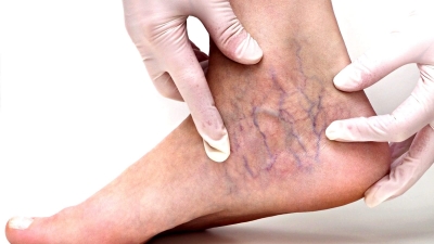 Αισθητική φλεβολογία: Aντιμετώπιση ευρυαγγειών και κιρσών