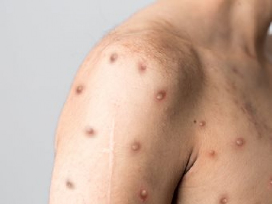 Ευλογιά των πιθήκων: Περισσότερα από 1.000 κρούσματα σε 29 χώρες - Μπορεί να γίνει ενδημική η νόσος