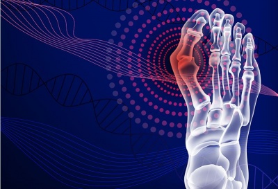 Βλαισός μέγας δάκτυλος (κότσι): Παρελθόν χάρη στη διόρθωση με διαδερμική τεχνική τρίτης γενιάς