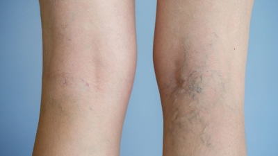 Αιμοδυναμική θεραπεία των κιρσών των κάτω άκρων