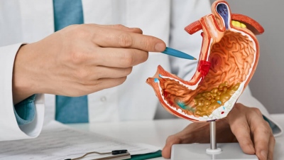 Καούρες: Γαστρο-οισοφαγική παλινδρόμηση ή διαφραγματοκήλη;