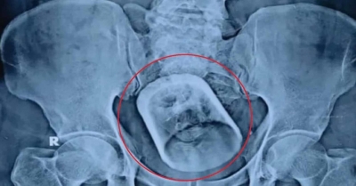 Άναυδοι οι γιατροί - Άντρας βρέθηκε με γυάλινο ποτήρι στο έντερο: «Έπινα τσάι και το... κατάπια»