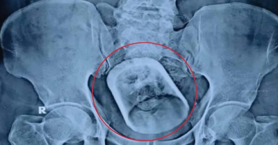 Άναυδοι οι γιατροί - Άντρας βρέθηκε με γυάλινο ποτήρι στο έντερο: «Έπινα τσάι και το... κατάπια»