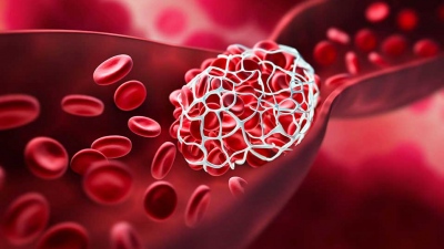 Παγκόσμια Ημέρα Θρόμβωσης - Μια σιωπηλή απειλή που μπορούμε να προλάβουμε