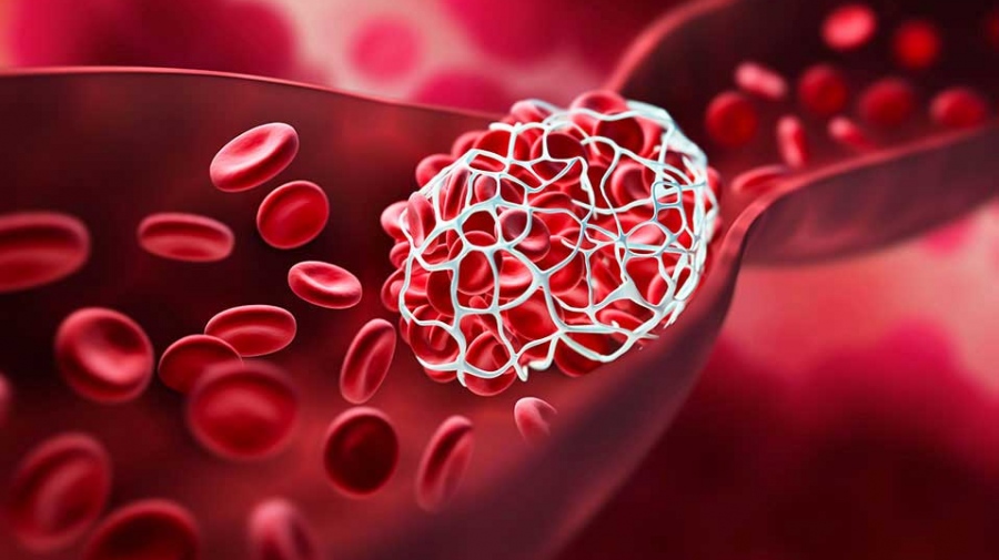 Παγκόσμια Ημέρα Θρόμβωσης - Μια σιωπηλή απειλή που μπορούμε να προλάβουμε