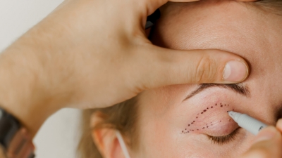 Βλεφαροπλαστική: Ανανεώστε το βλέμμα σας