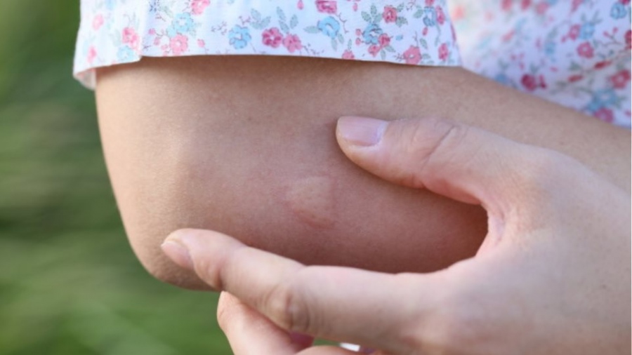 ΕΟΔΥ: Στις Σέρρες το πρώτο περιστατικό λοίμωξης από τον ιό του Δυτικού Νείλου