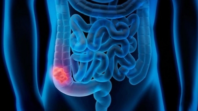 Κολονοσκόπηση: Μια εξέταση που σώζει ζωές