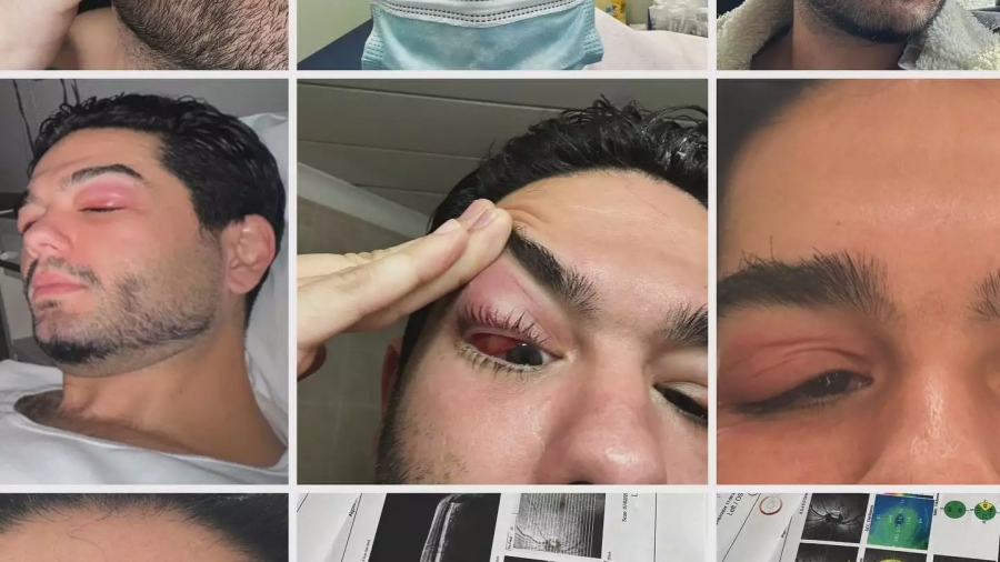 Οι αποκαλυπτικές φωτογραφίες για το πρόβλημα υγείας που αντιμετώπισε ο Χρήστος Μάστορας - Τι του προκάλεσε ο covid