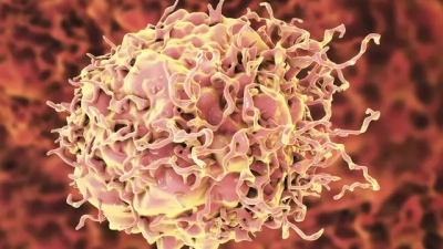 Μυέλωμα, λευχαιμία και άλλοι καρκίνοι που συνδέονται με τον covid 19 - Έχει μακροχρόνιες ανοσοτροποποιητικές επιδράσεις