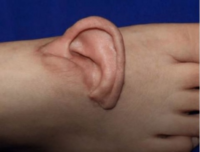 Δεν είναι ταινία τρόμου... είναι αλήθεια: Γιατροί έσωσαν κομμένο αυτί, φυτεύοντάς το στο πόδι