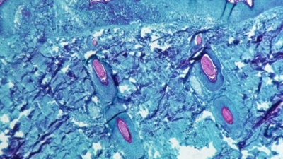 ΗΠΑ – Ευλογιά των πιθήκων: Τα πρώτα κρούσματα σε παιδιά – Καλά στην υγεία τους τα δύο παιδιά