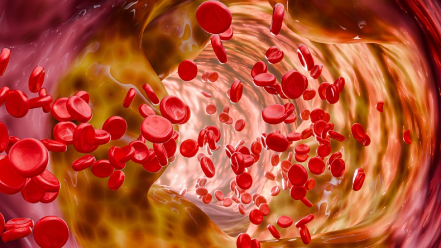 Περιφερική αρτηριοπάθεια - Διάγνωση και σύγχρονες θεραπευτικές επιλογές