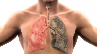 Επαναστατική ενδοσκοπική μέθοδος δίνει «λύση-ανάσα» στη χρόνια αποφρακτική πνευμονοπάθεια