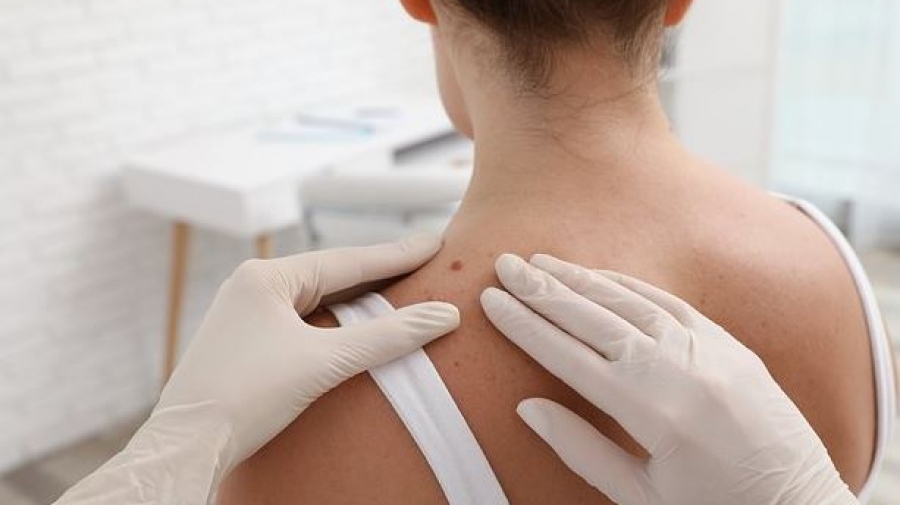 Δερματολόγος αναλύει το μύθο για τη σύνδεση μεταξύ της αφαίρεσης ελιάς και της εμφάνισης καρκίνου