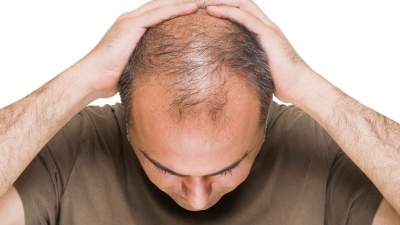 Τριχόπτωση σε άνδρες