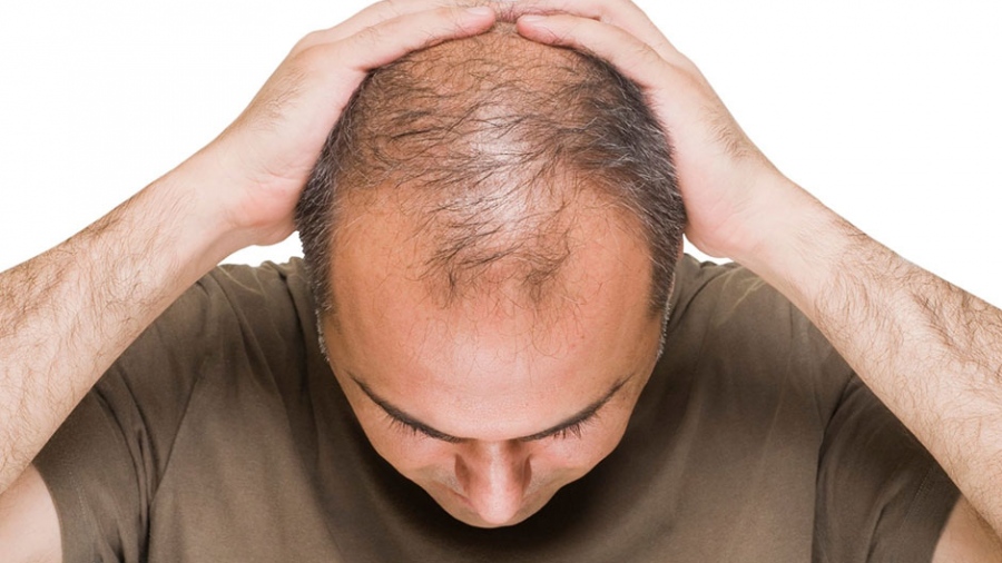Τριχόπτωση σε άνδρες