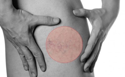 Αναίμακτη & ανώδυνη θεραπεία των κιρσών