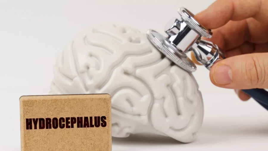 Υδροκέφαλος σε παιδιά: Τι είναι και ποια  είναι τα συμπτώματα;
