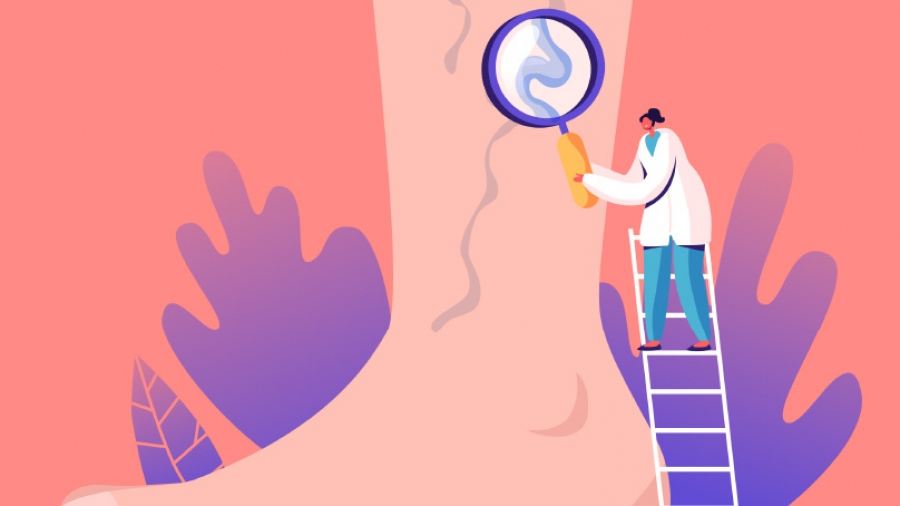 Οι 18 ερωτήσεις και απαντήσεις σχετικά με τους κιρσούς των κάτω άκρων