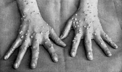 Tα πρώτο κρούσματα ευλογιάς των πιθήκων σε Ουγγαρία και Νορβηγία