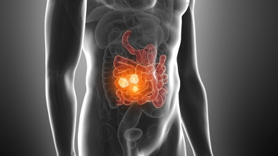 Ορθοκολικός Καρκίνος - Τα κυριότερα συμπτώματα, η διάγνωση και η αντιμετώπιση