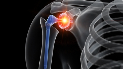 Αρθροπλαστική ώμου - Ο ρόλος της νέας τεχνολογίας