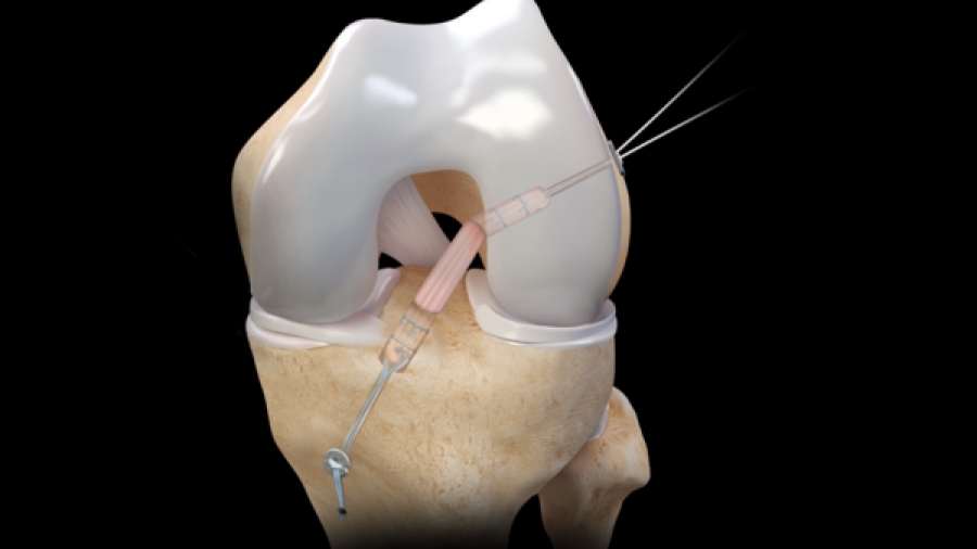 Ρήξη πρόσθιου χιαστού: Αντιμετώπιση με την τεχνική All Inside