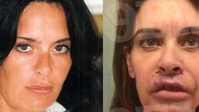 Νέκρωσαν τα χείλη της συγγραφέως Κατερίνας Πλουμιδάκη μετά από πλαστική: Σοκάρουν οι εικόνες - 7 χειρουργεία, 22 γιατροί