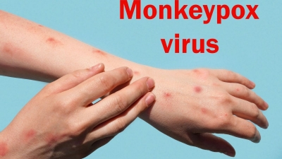 Ευλογιά των πιθήκων: Δύο τα επιβεβαιωμένα κρούσματα στην Ελλάδα - ΕΟΔΥ: Αφορούν σε West Africa clade