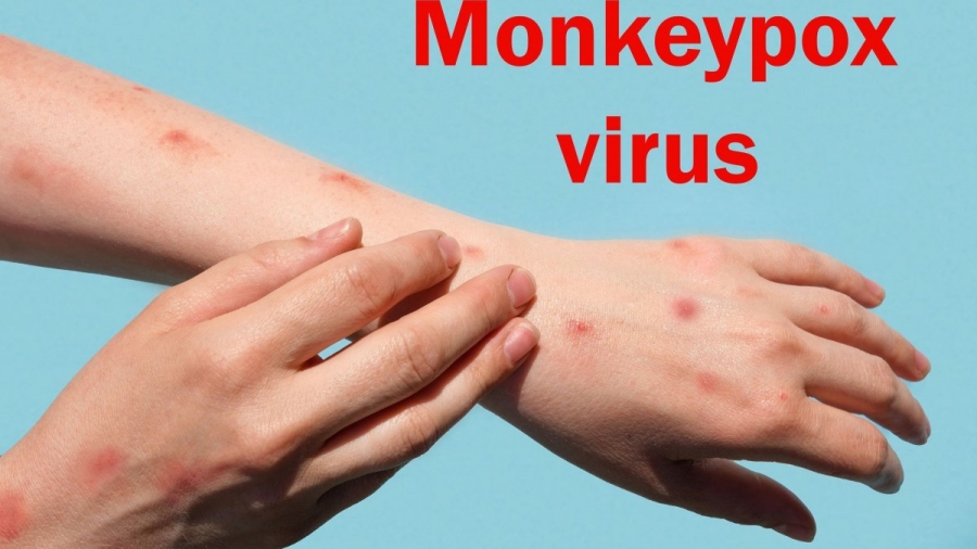 Ευλογιά των πιθήκων: Δύο τα επιβεβαιωμένα κρούσματα στην Ελλάδα - ΕΟΔΥ: Αφορούν σε West Africa clade