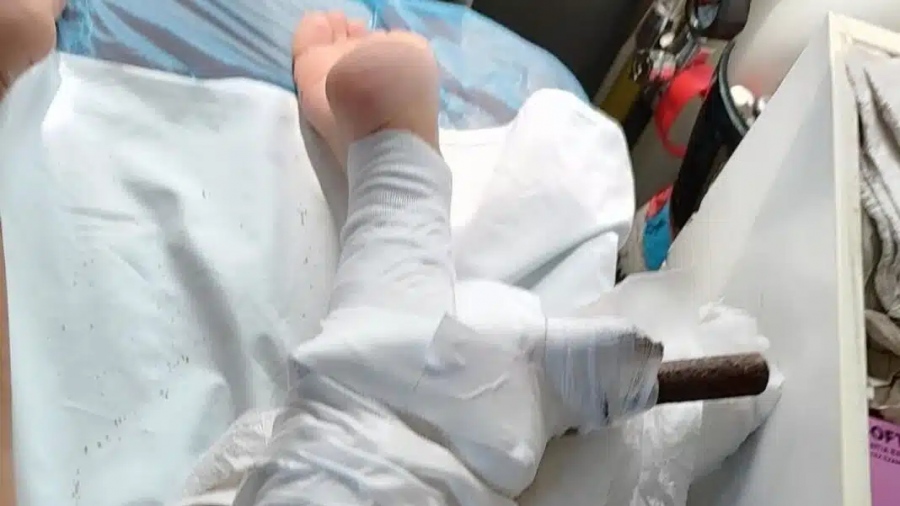 Σοκ στην Χαλκιδική: Ομπρέλα καρφώθηκε στο πόδι 26χρονης