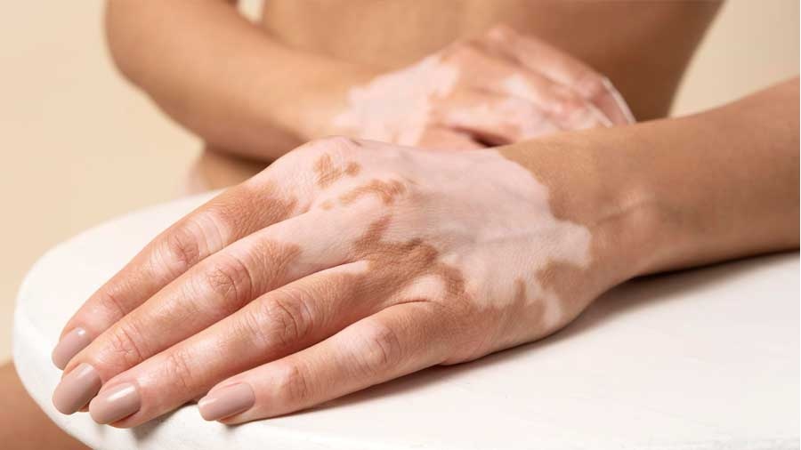 Λεύκη: Νέα κρέμα για την αντιμετώπισή της