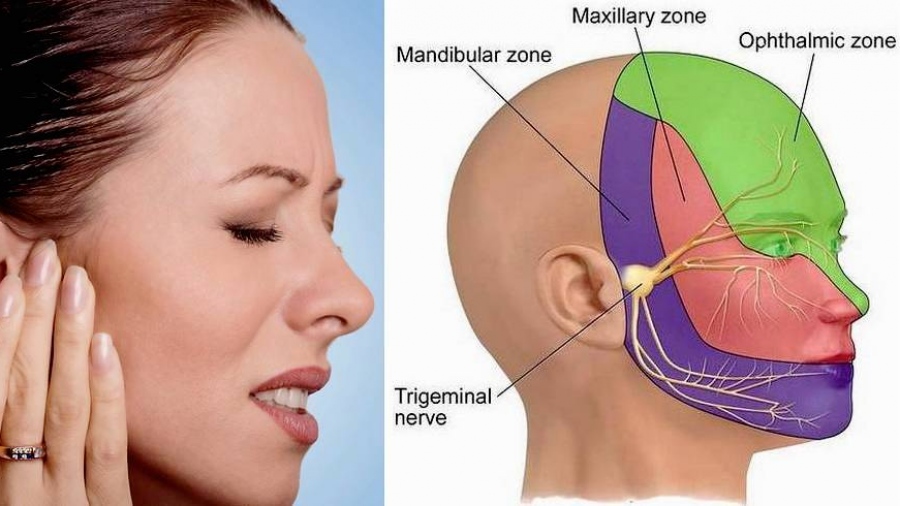 Νευραλγία Τριδύμου - Ένα χρόνιο σύνδρομο