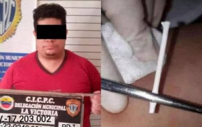 Απίστευτη απάτη: Ψευτογιατρός εμφύτευε… ξυλάκια από γλειφιτζούρια κάτω από το δέρμα γυναικών ως αντισυλληπτικό