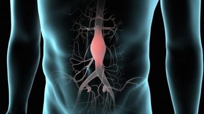 Ανεύρυσμα κοιλιακής αορτής - Παράγοντες κινδύνου, συμπτώματα και θεραπεία