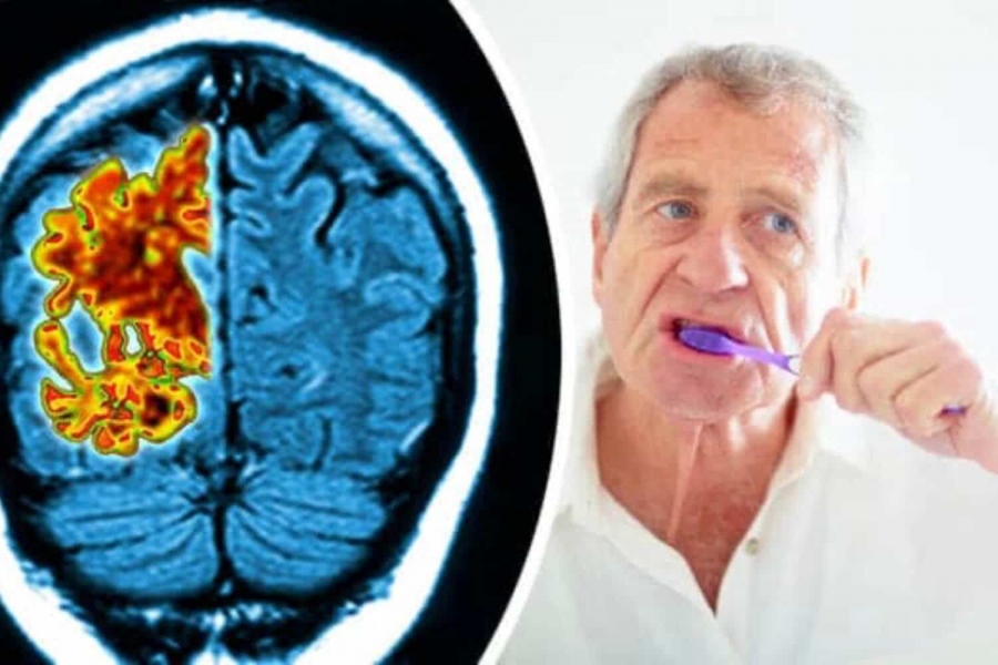 Αδιανόητη σύνδεση - Πηγαίνετε οδοντίατρο για να μην πάθετε... Alzheimer! - Η ανησυχητική σχέση δοντιών και νόσου