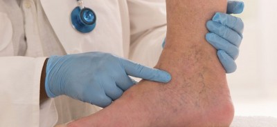 Θρόμβωση: Μια συχνή πάθηση που υποτιμούμε