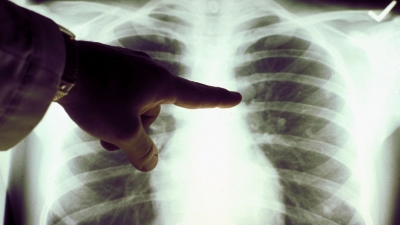 Καρκίνος του Πνεύμονα: Χρήσιμες γνώσεις και πληροφορίες για ασθενείς