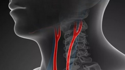 Στένωση καρωτίδων - Το «σιωπηλό» αίτιο του εγκεφαλικού επεισοδίου
