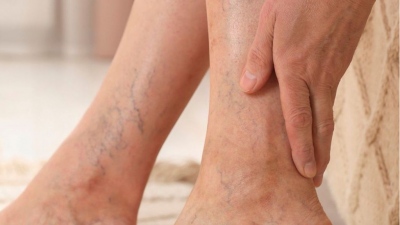 Γιατί πρέπει να χειρουργηθούν οι κιρσοί στα πόδια μου;