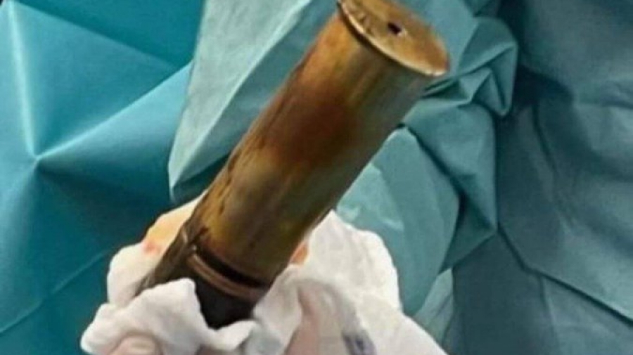 Σοκ στη Γαλλία: Ηλικιωμένος έφτασε στο νοσοκομείο με οβίδα του Α’ Παγκοσμίου στον πρωκτό - Εκκενώθηκε ο χώρος, κίνδυνος έκρηξης!
