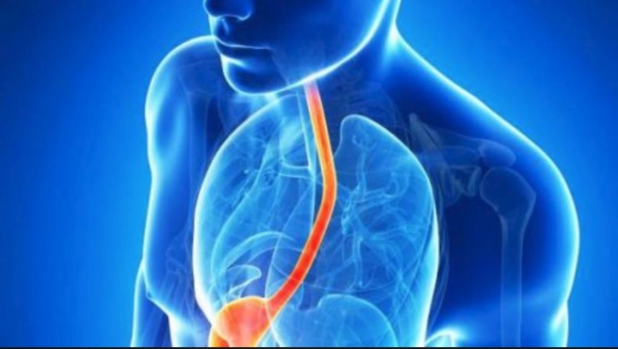 Γαστροοισοφαγική παλινδρόμηση