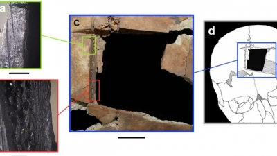 Ο άνθρωπος με την τετράγωνη τρύπα στο... κρανίο: Ένδειξη χειρουργικής επέμβασης πριν 3.500 χρόνια - Βρέθηκε στο Ισραήλ