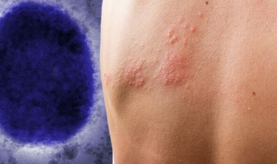 ΕΟΔΥ: Δεν έχει καταγραφεί κρούσμα ευλογιάς των πιθήκων στην Ελλάδα – Μικρή η μεταδοτικότητα