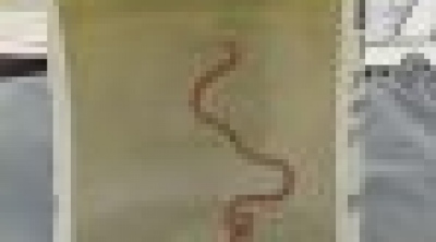 Σοκ: Ζωντανό σκουλήκι 8 εκατοστών αφαιρέθηκε από τον εγκέφαλο γυναίκας - Από το έντερο πήγε σε άλλα όργανα