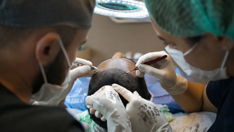 Σπεύδουν στην Τουρκία για... μεταμόσχευση μαλλιών - Από 1.500 έως 2.000 ευρώ τα all inclusive πακέτα