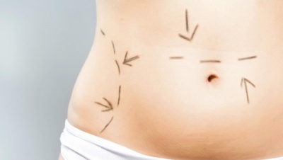 Λιποαναρρόφηση: Tι πρέπει να γνωρίζετε